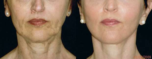 Face/Neck Lift Before and After Photo Dr. Alfred Cohen in Beverly Hills, CA